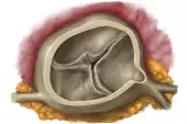  © MEDICAL GRAPHICS/MICHAEL HOFFMANN/SPL