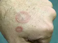 Fig 1. Annular lesions Fig 1. Annular lesions