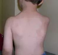 Fig 3. Annular psoriasis Fig 3. Annular psoriasis