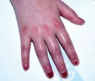 Fig 5. Kawasaki disease.