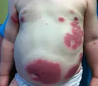 Fig. Palpable eruption