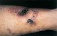 Fig 1. Skin necrosis Fig 1. Skin necrosis