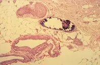 Fig 2. Vascular calcification Fig 2. Vascular calcification
