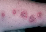 Fig 1. Pustular lesions Fig 1. Pustular lesions