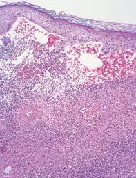 Fig 2. Subepidermal blister Fig 2. Subepidermal blister