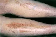 Fig 1. Pigmented patches Fig 1. Pigmented patches