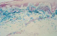 Fig 2. Skin biopsy