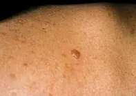 Fig 1. Pearly nodule Fig 1. Pearly nodule