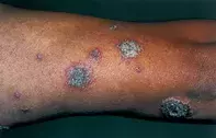 Fig 1. Crusted lesions Fig 1. Crusted lesions
