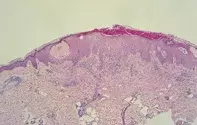 Fig 2. Serum and inflammation Fig 2. Serum and inflammation