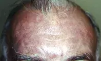 Fig 1. Slate-grey pigmentation Fig 1. Slate-grey pigmentation
