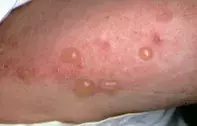 Fig 1. Tense blisters Fig 1. Tense blisters
