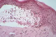 Fig 2. Subepidermal blister Fig 2. Subepidermal blister