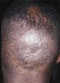 Fig 1. Follicular cysts