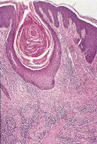 Fig 2. Scalp biopsy Fig 2. Scalp biopsy