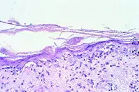 Fig 2. Atrophic epidermis Fig 2. Atrophic epidermis
