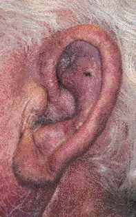 Fig 1. Dusky erythema Fig 1. Dusky erythema