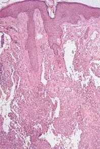 Fig 2. Vascular channels Fig 2. Vascular channels