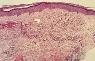 Fig 2. Dermal scarring Fig 2. Dermal scarring