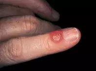 Fig 1. Translucent cyst Fig 1. Translucent cyst