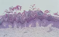 Fig 2. Papillomatous epidermis Fig 2. Papillomatous epidermis