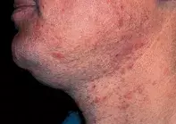 Fig 1. Irritable rash Fig 1. Irritable rash