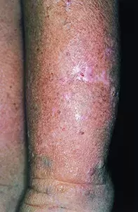 Fig 1. Pretibial skin Fig 1. Pretibial skin