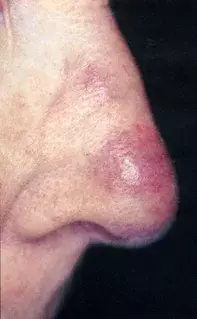 Fig 1. Nodule on nose