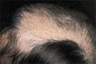 Fig 1. Alopecia Fig 1. Alopecia
