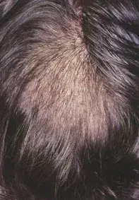 Fig 1. Diffuse alopecia Fig 1. Diffuse alopecia