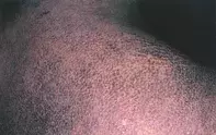 Fig 1. Hyperpigmentation Fig 1. Hyperpigmentation