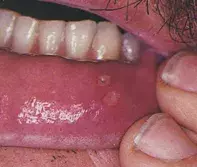 Fig 1. Mouth ulcers Fig 1. Mouth ulcers