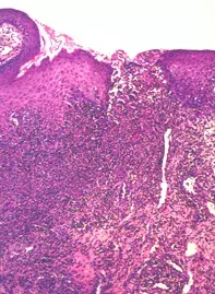 Fig 2. Mucosal biopsy