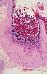 Fig 2. Skin biopsy