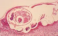 Fig 2. Shave biopsy Fig 2. Shave biopsy
