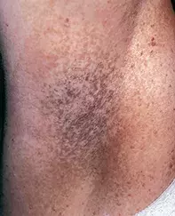 Fig 1. Reticular pigmentation Fig 1. Reticular pigmentation