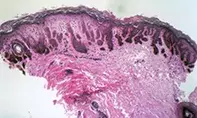 Fig 2. Skin biopsy Fig 2. Skin biopsy