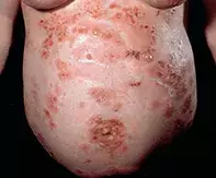 Fig 1. Symmetrical rash Fig 1. Symmetrical rash