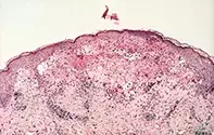 Fig 2. Skin biopsy