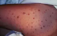 Fig 1. Purpuric rash. Fig 1. Purpuric rash.