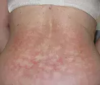 Fig. Eruption on back Fig. Eruption on back